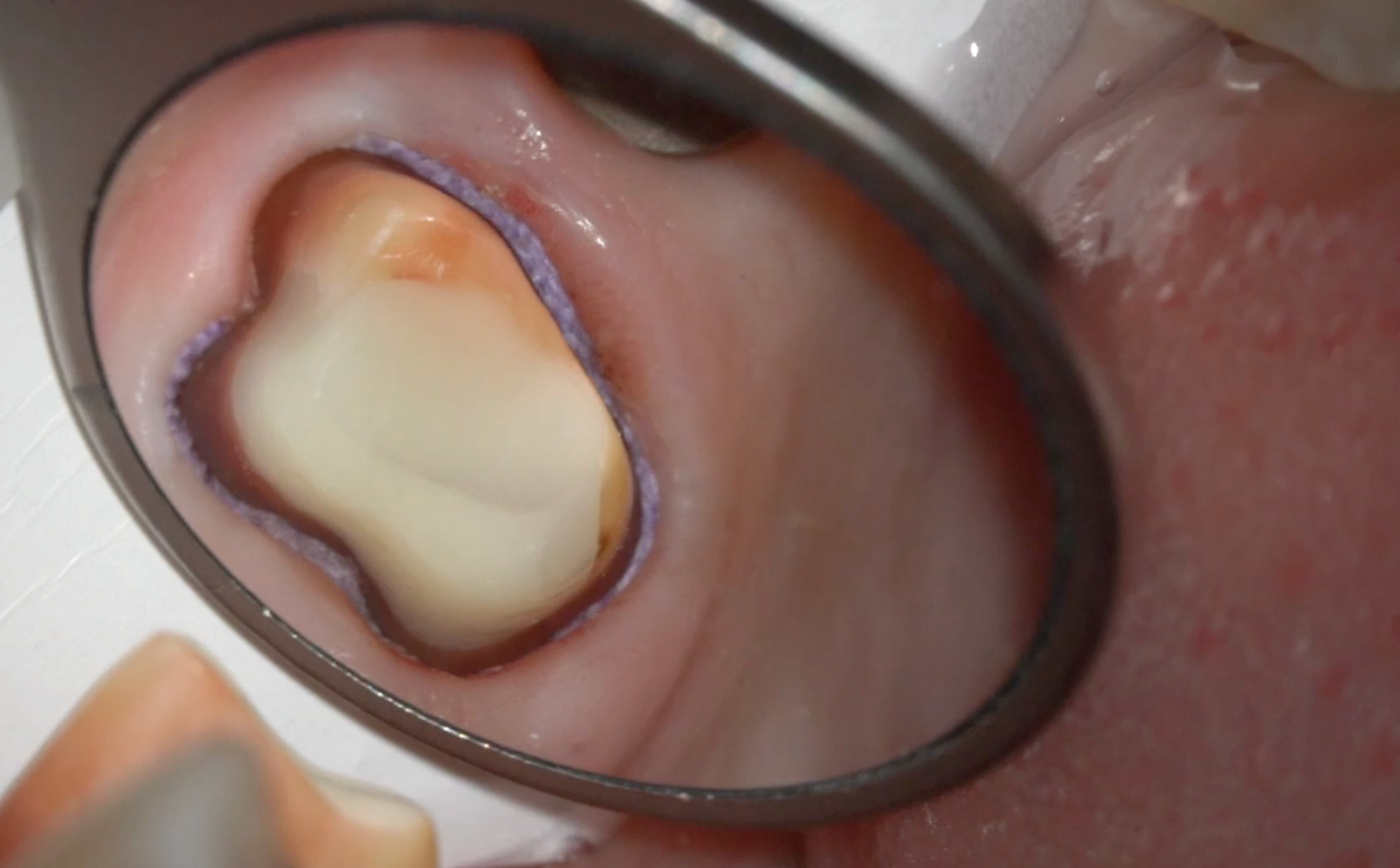 Подготовка зуба 2.7 под полную коронку, получение оттиска 2.7 и имплантата 2.6, фиксация коронок